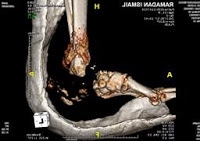 Preoperative CT film